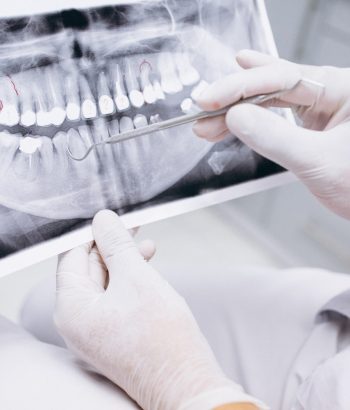 los cuidados tras implantes dentales